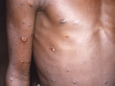 FILE - This 1997 image provided by U.S. Centers for Disease Control and Prevention shows the right arm and torso of a patient, whose skin displayed a number of lesions due to what had been an active case of monkeypox. As health authorities in Europe and elsewhere roll out vaccines and drugs to stamp out the biggest monkeypox outbreak beyond Africa, in 2022, some doctors are acknowledging an ugly reality: The resources to slow the disease's spread have long been available, just not to the Africans who have dealt with it for decades. (CDC via AP, File)