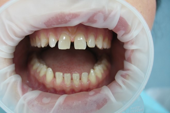 Nepravilno oblikovani zobje prej ... 